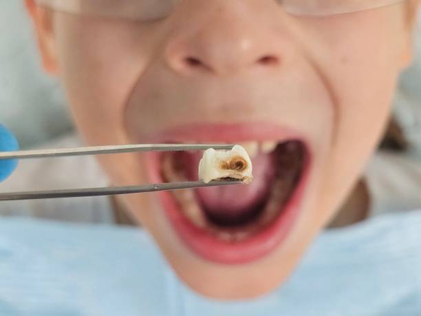 Best Emergency Tooth Extraction in Colusa, CA